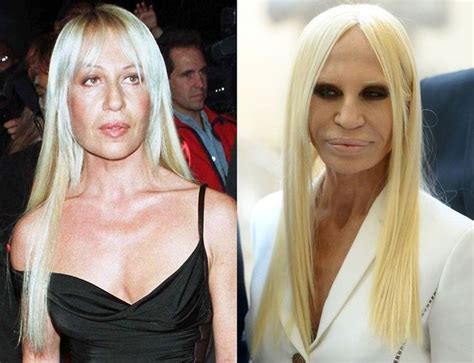 donatella Versace plastic surgery